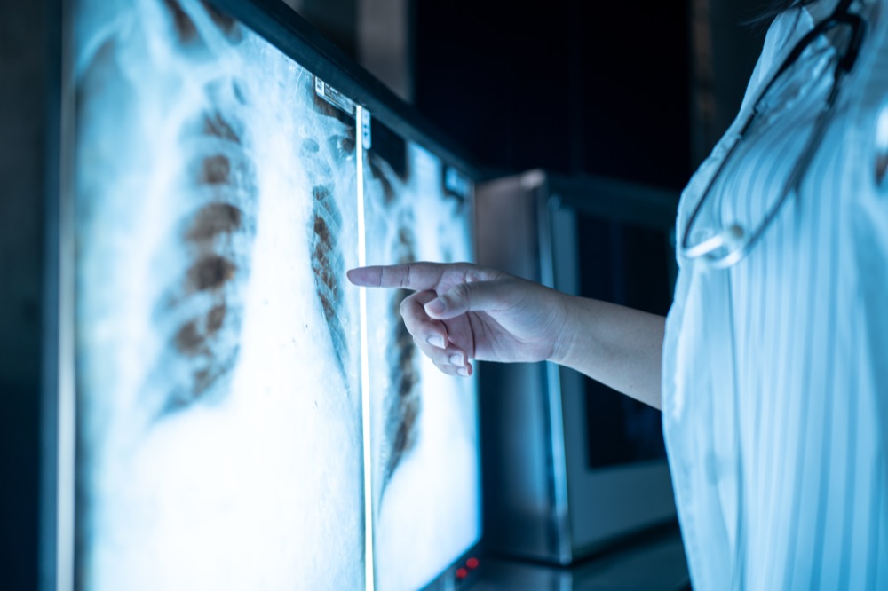 A doctor pointing at chest X-rays on a lightbox